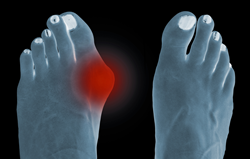 Dr. Tomasz Biernacki DPM Podiatrist & Foot Doctor in Royal Oak Michigan discusses minimally invasive bunion surgery.