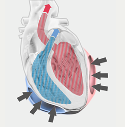 Heart with implant, sectioned, inflated cushions