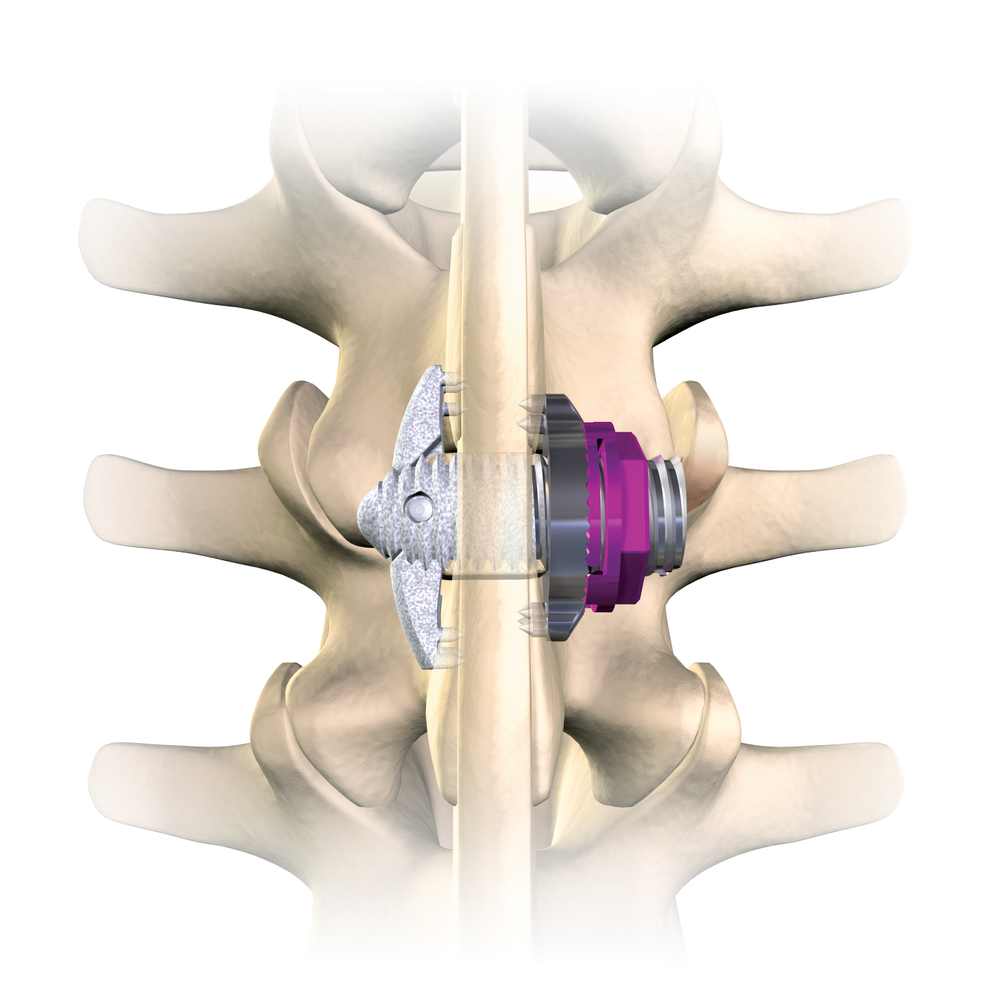 The MinuteMan serves a dual role as both spacer and fusion device, giving the spine greater stability.