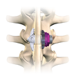 Posterior spine view of Spinal Simplicity Minuteman G3R device