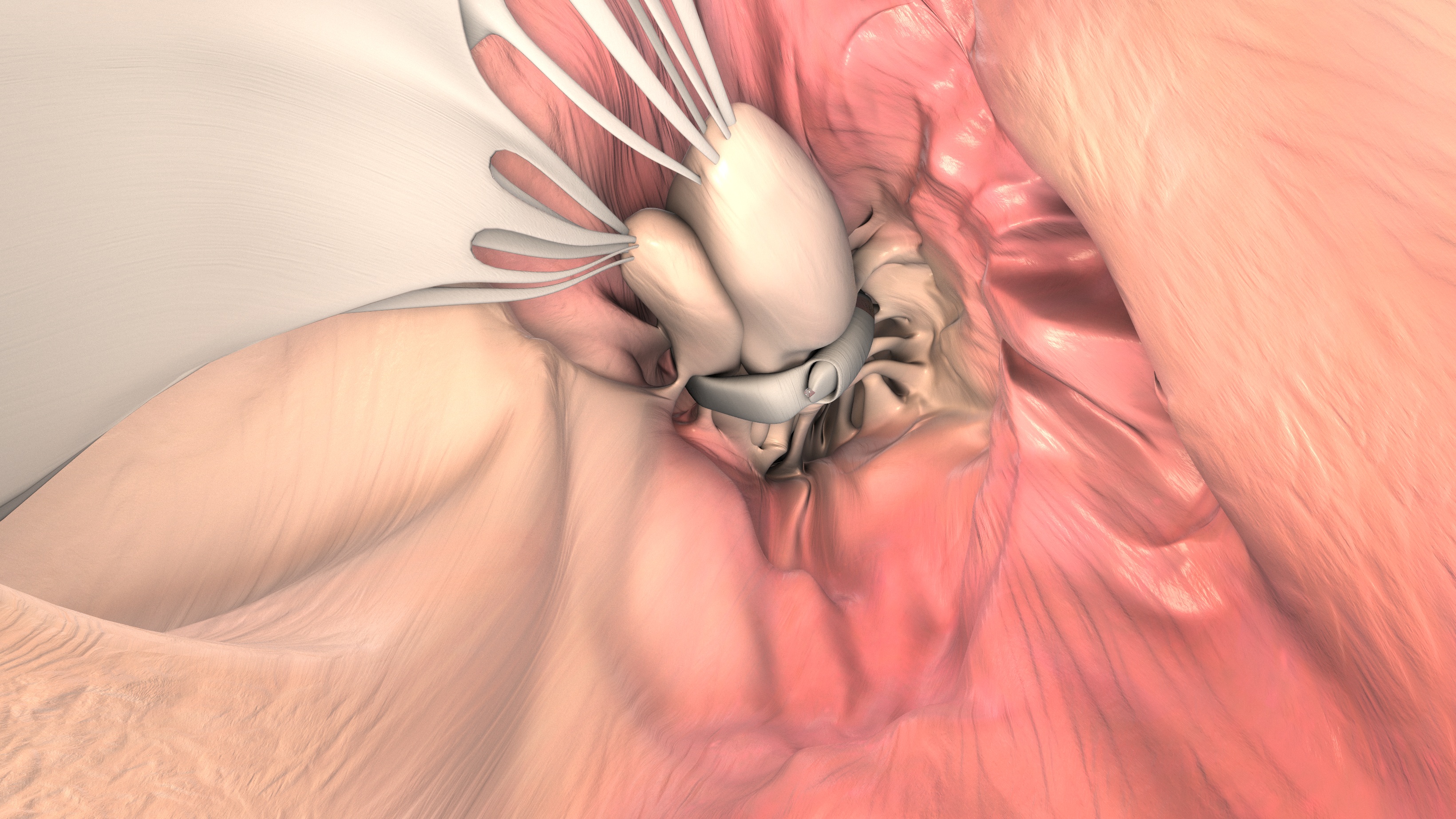 V-sling implant treating heart failure with left ventricle dilation