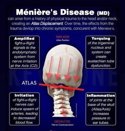 Have Meniere's Disease?