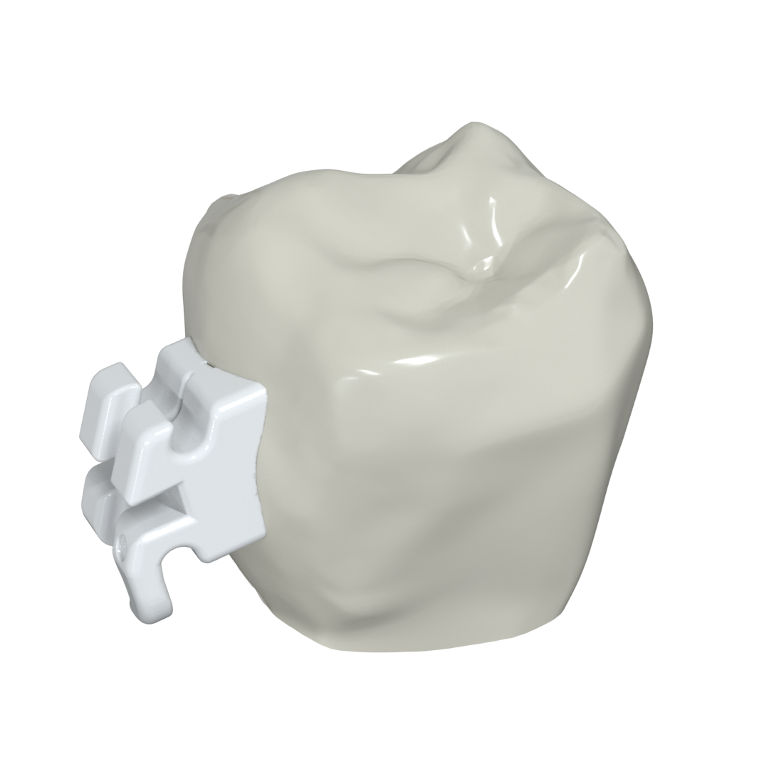 LightForce Orthodontics Custom Bracket