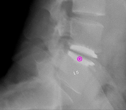 Degeneration of Lumbar Intervertebral Disc, Intervertebral Disc Disorder, Artificial Disc Replacement, Back Disc Replacement, Intervertebral Disc Arthroplasty