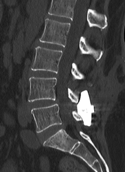 Spondylolisthesis, Spinal Fusion, Interspinous Device (IPD), Inspan