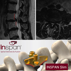 Spondylolisthesis with severe spinal stenosis and Inspan