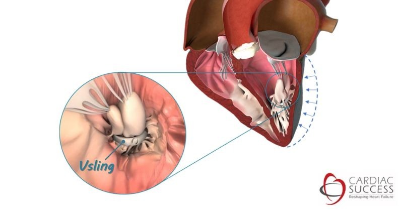 Cardiac Success V-sling system
