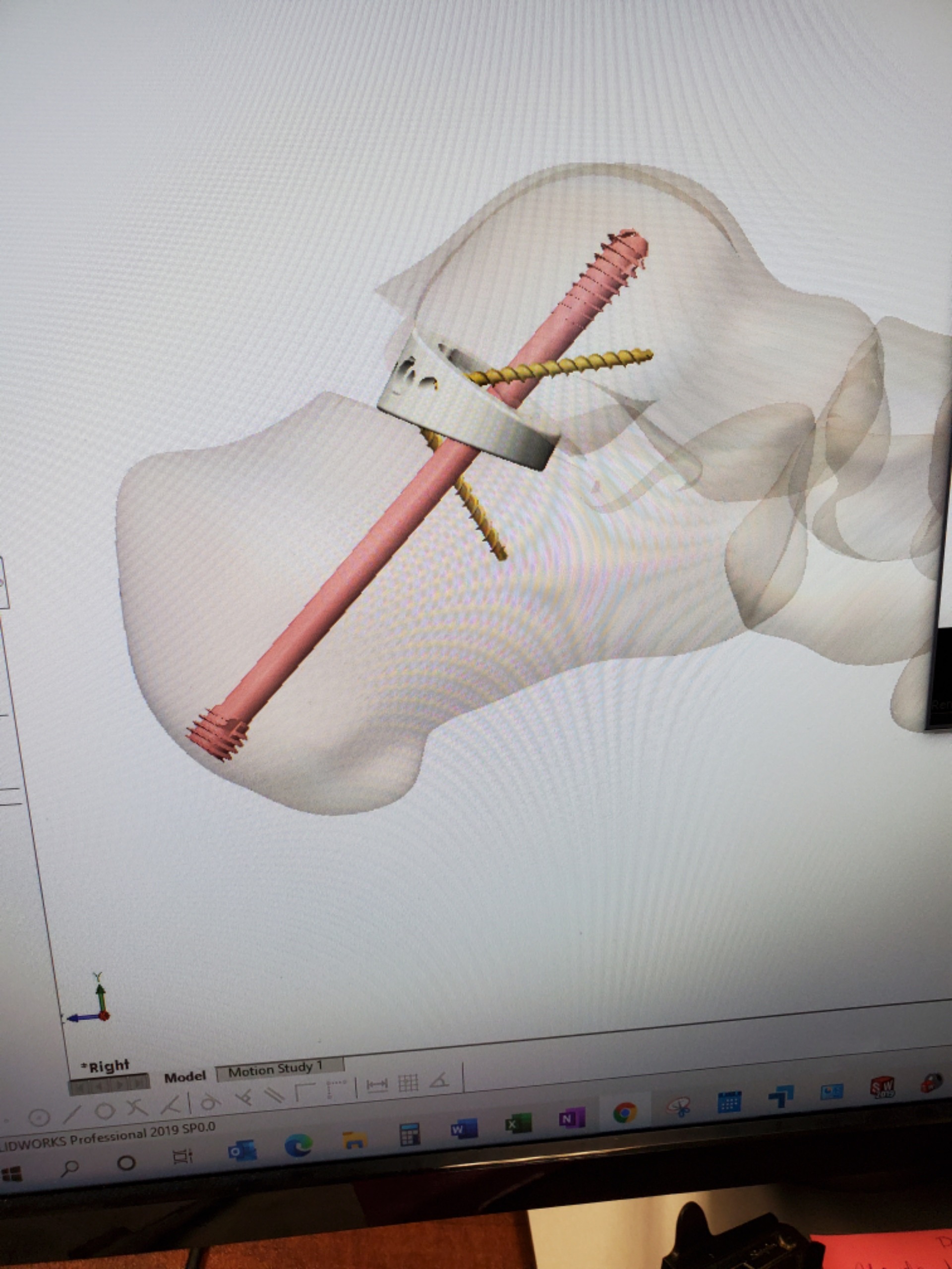 Trigon Subtalar Fusion Wedge