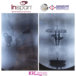 Dr. Erik Spayde placed an Inspan interlaminar interspinous fixation device to back up a lateral Nuvasive interbody cage in a lumbar fusion