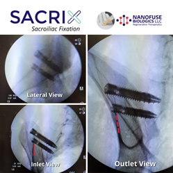 Percutaneous lateral-oblique Sacrix sacroiliac joint fixation screws