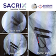 Sacrix The First To Use Navigation To Perform A Percutaneous Lateral-Oblique Sacroiliac Joint Fixation