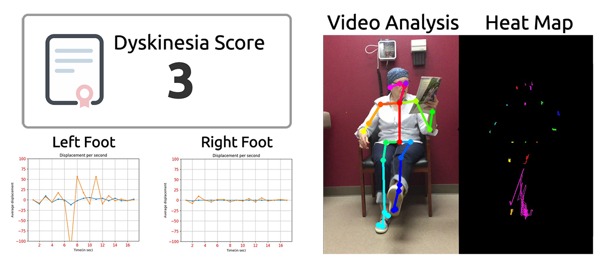 Tracer™ analysis of Parkinson's dyskinesia patient