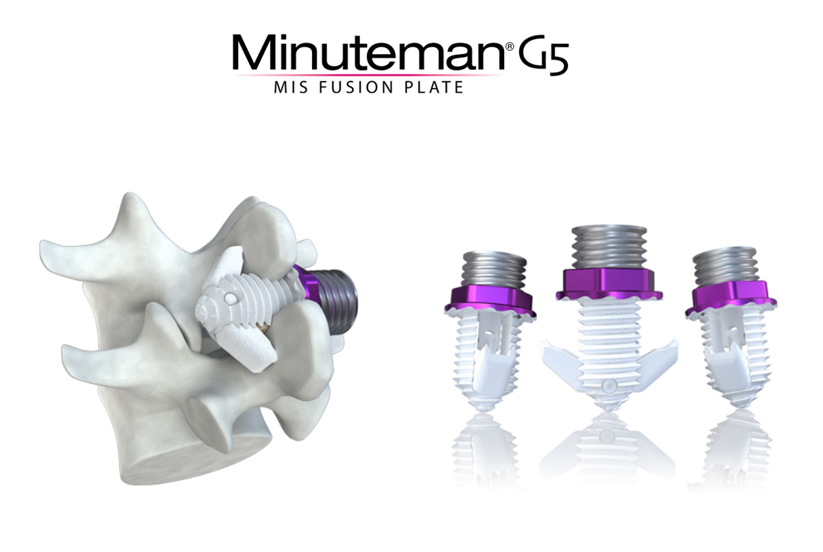 Spinal Simplicity Minuteman® G5 Implant