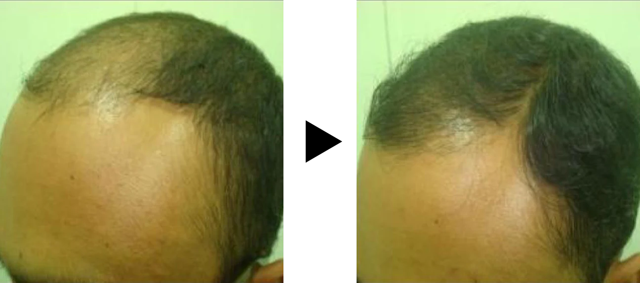 “Evalaution of Hair Growth, Rajendrasingh aka Rajesh Rajput, M.Ch. Fellow ISHRS, Hair Restore, Mumbai”