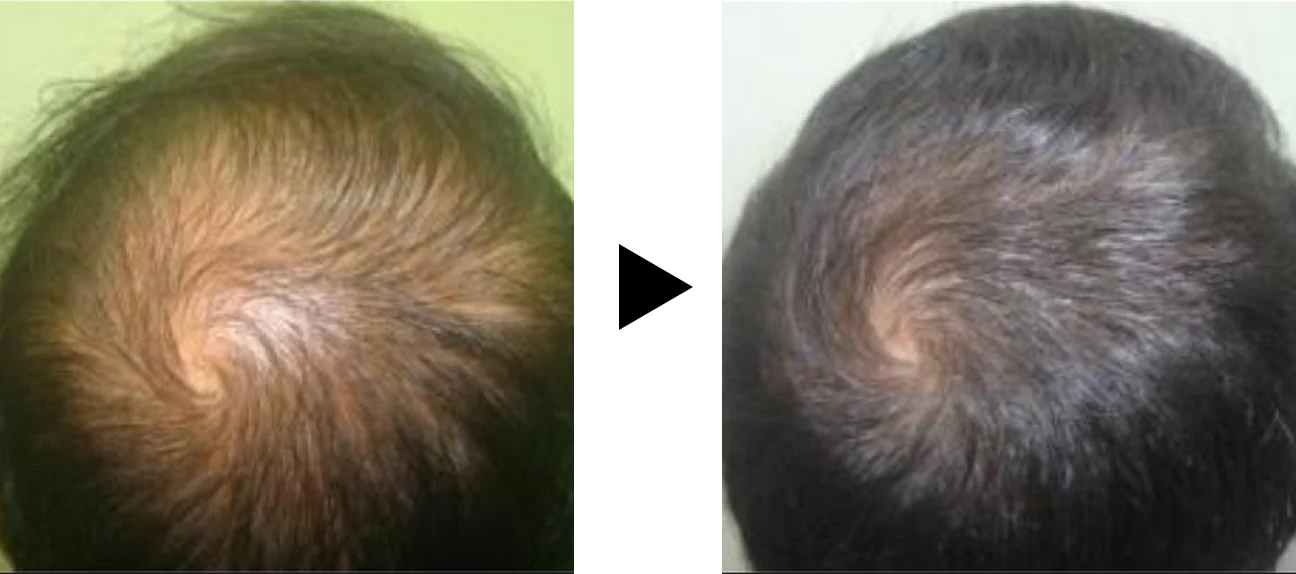 "Evalaution of Hair Growth, Rajendrasingh aka Rajesh Rajput, M.Ch. Fellow ISHRS, Hair Restore, Mumbai"