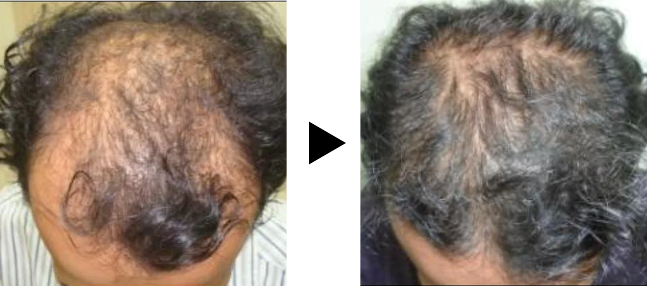 "Evalaution of Hair Growth, Rajendrasingh aka Rajesh Rajput, M.Ch. Fellow ISHRS, Hair Restore, Mumbai"