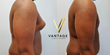 Top NYC Plastic Surgeon, Dr. Aleksandr Shteynberg has Pioneered a Breakthrough in Gynecomastia Surgery for Men Looking to Reduce Their Breast Size