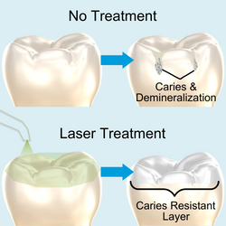 Irradiation with 9.3µm CO2 laser can make surface mineral layer more caries resistant