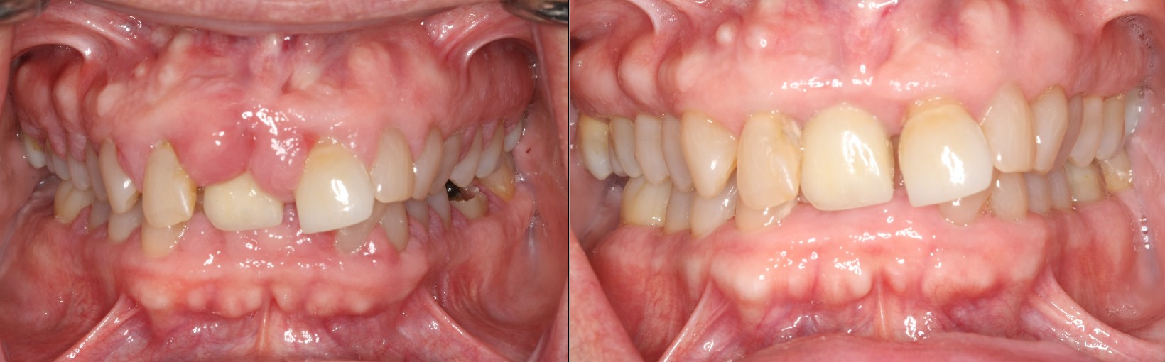Before and After Treatment for Gingival Hyperplasia and Discontinuation of a Calcium Channel Blocker